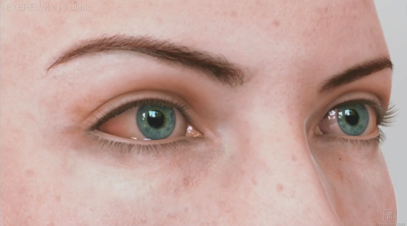 렌즈를 사용하게 되면 왜 눈이 충혈될까요? 