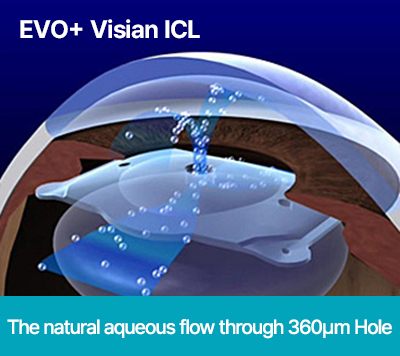 EVO+ Visian ICL™-The natural aqueous flow through 360㎛ Hole