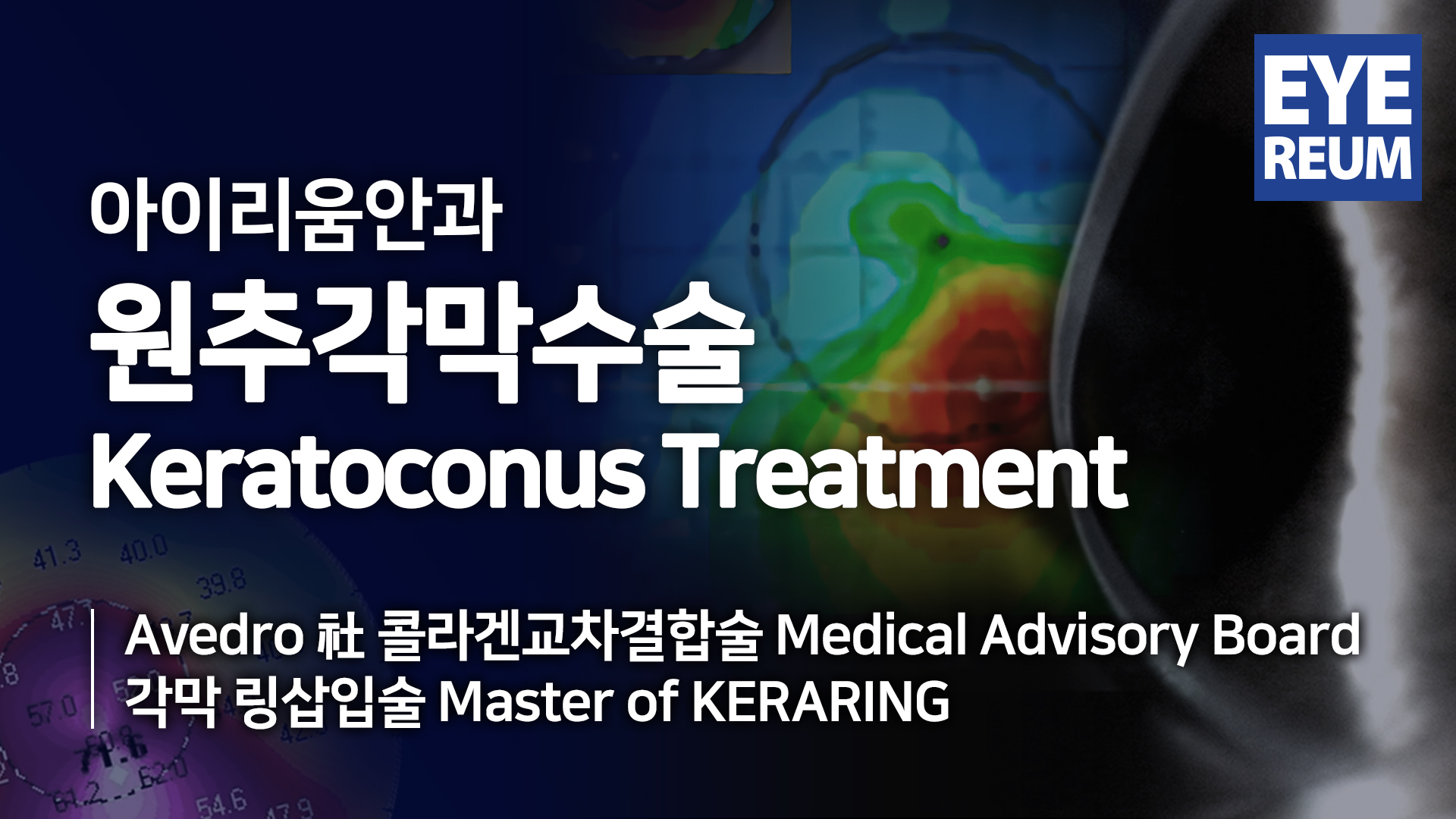 원추각막(각막확장증)이란? | 아이리움안과