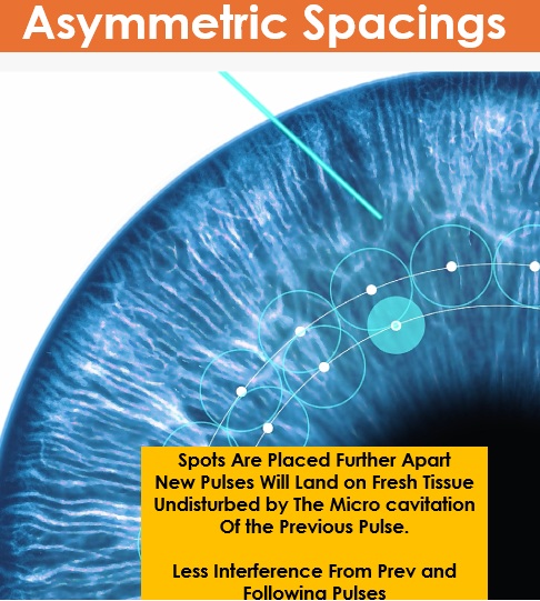 Reducing Higher-Order Aberrations in KLEx through Asymmetric Laser Spacing(JCRS)