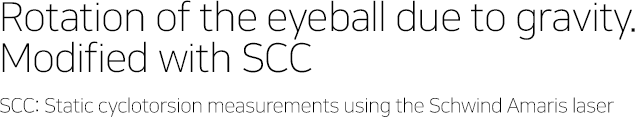 Rotation of the eyeball due to gravity. Modified with SCC SCC: Static cyclotorsion measurements using the Schwind Amaris laser
