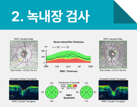 2. 녹내장 검사